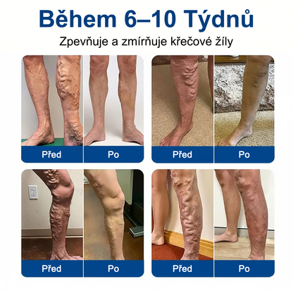 FLORISMA® plaster mikroigłowy z diosminą i hesperydyną o formule klasy klinicznej🌿 — ukierunkowany na żylaki i pajączki naczyniowe, łagodzi uczucie ciężkich i zmęczonych nóg