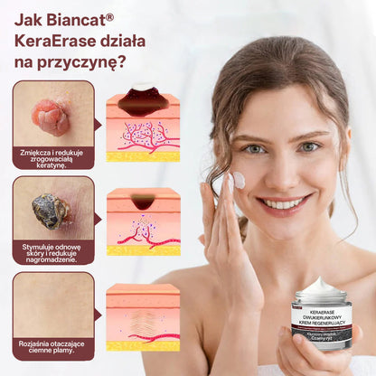 💎 Biancat® KeraErase Dwukierunkowy Krem Regenerujący 👨‍⚕️ (do leczenia brodawek, narośli skórnych, plam oraz hiperpigmentacji)