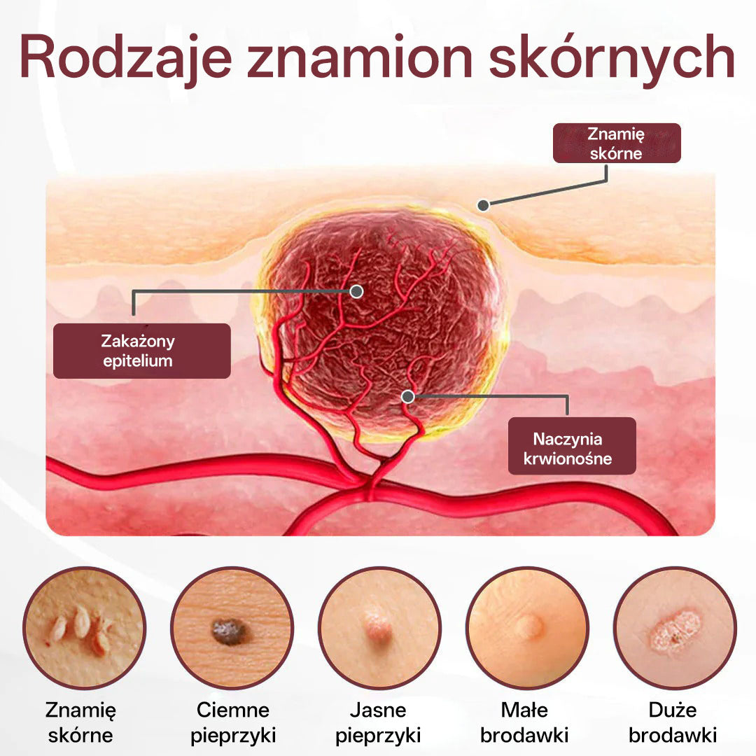 💎 Biancat® KeraErase Dwukierunkowy Krem Regenerujący 👨‍⚕️ (do leczenia brodawek, narośli skórnych, plam oraz hiperpigmentacji)