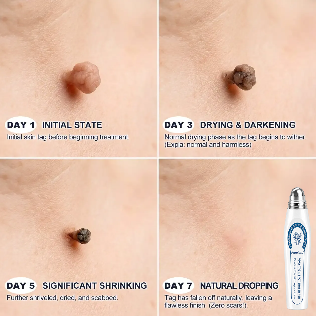 Pureluxo® 💥7-Day Tag & Spot Eraser (Zero Pain, Zero Scars Rollerball)