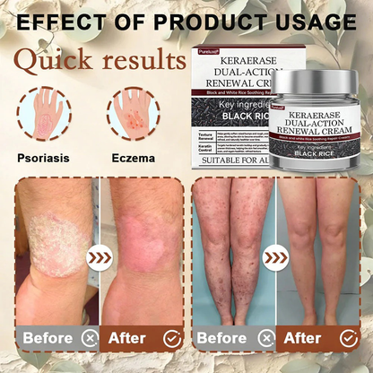 Pureluxo® KeraErase Dual-Action Renewal Cream 🌟(removes warts and skin growths, senile purpura)