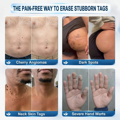 Pureluxo® 🌟7-Day Tag & Spot Eraser (Zero Pain, Zero Scars Rollerball)